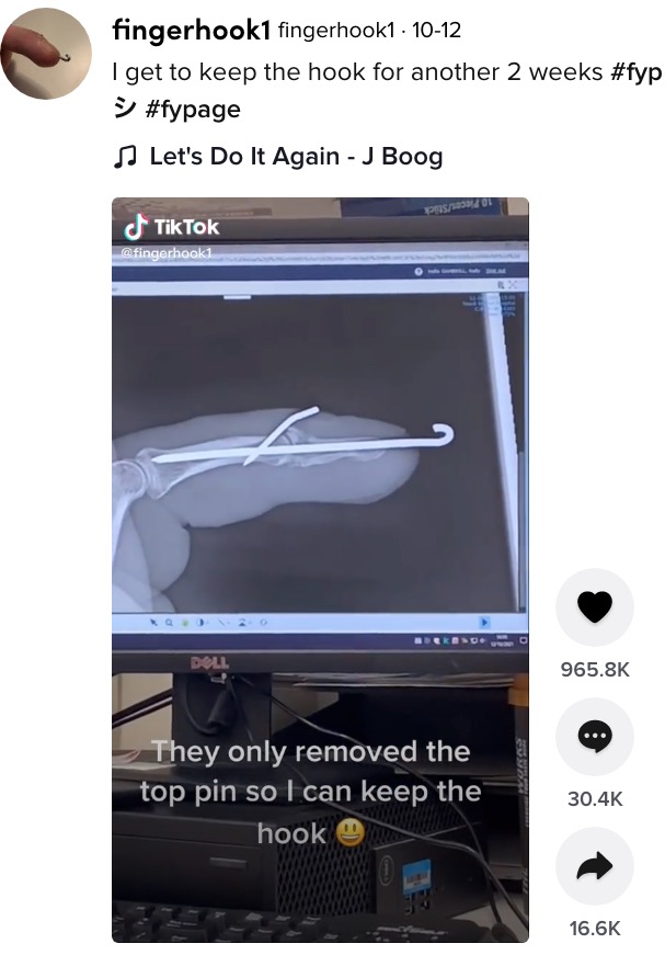 男性が医師から見せられたX線写真（画像は『fingerhook1　2021年10月12日付TikTok「I get to keep the hook for another 2 weeks」』のスクリーンショット）