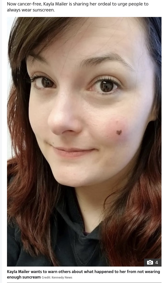 ハート型のほくろがチャームポイントだった女性（画像は『The Sun　2021年11月18日付「FATAL FRECKLE I loved the heart-shaped freckle on my face - until doctors told me it could kill me」（Credit: Kennedy News）』のスクリーンショット）