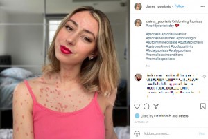 病気を受け入れられるようになったというクレアさん（画像は『Claire Elizabeth　2021年10月30日付Instagram「Celebrating Psoriasis」』のスクリーンショット）