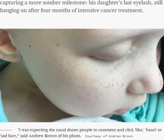 がんの治療でまつ毛1本だけが残った女児（画像は『TODAY　2016年11月11日付「Dad’s heartbreaking photo shows daughter’s last eyelash as she fights cancer」（Courtesy of Andrew Brown）』のスクリーンショット）