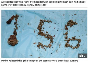 全ての結石を取り出すとその数は156個に（画像は『The Sun　2021年12月18日付「PEBBLE SCREECH Man, 50, has ‘record-breaking’ 156 kidney stones removed by docs during 3-hour surgery after agonising stomach pain」』のスクリーンショット）