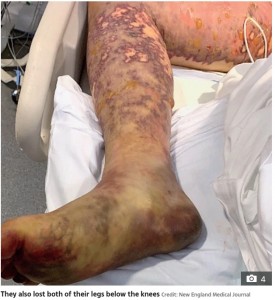 足を切断することに…（画像は『The Sun　2022年2月21日付「HORROR MEAL Student has both legs amputated after eating pal’s leftover takeaway in fridge which caused life-threatening sepsis」（Credit: New England Medical Journal）』のスクリーンショット）