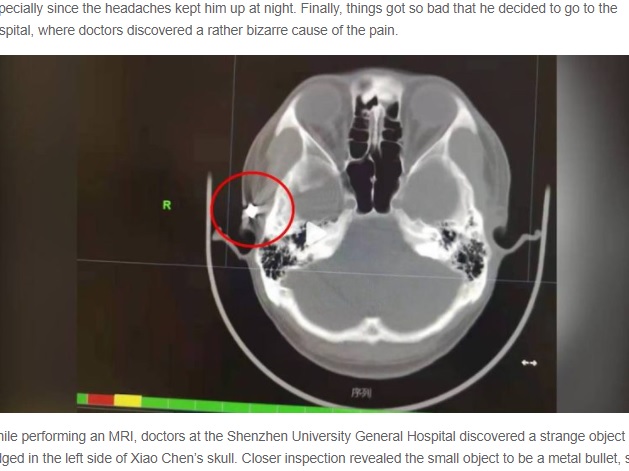 頭蓋骨の中に留まっていた空気銃弾（画像は『Oddity Central　2022年2月1日付「Man Suffering From Severe Headaches Lived With Bullet in His Skull for 20 Years」』のスクリーンショット）