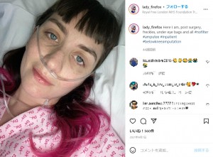 昨年4月に左脚の切断手術を受けたローラさん（画像は『Lady firefox　2021年4月7日付Instagram「Here I am, post surgery, freckles, under eye bags and all ＃nofilter」』のスクリーンショット）