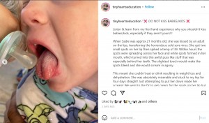 発疹は舌の上にも（画像は『Follow for EMPOWERMENT　2022年2月10日付Instagram「DO NOT KISS BABIES/KIDS」』のスクリーンショット）