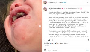 口の周りには多数の発疹が（画像は『Follow for EMPOWERMENT　2022年2月10日付Instagram「DO NOT KISS BABIES/KIDS」』のスクリーンショット）