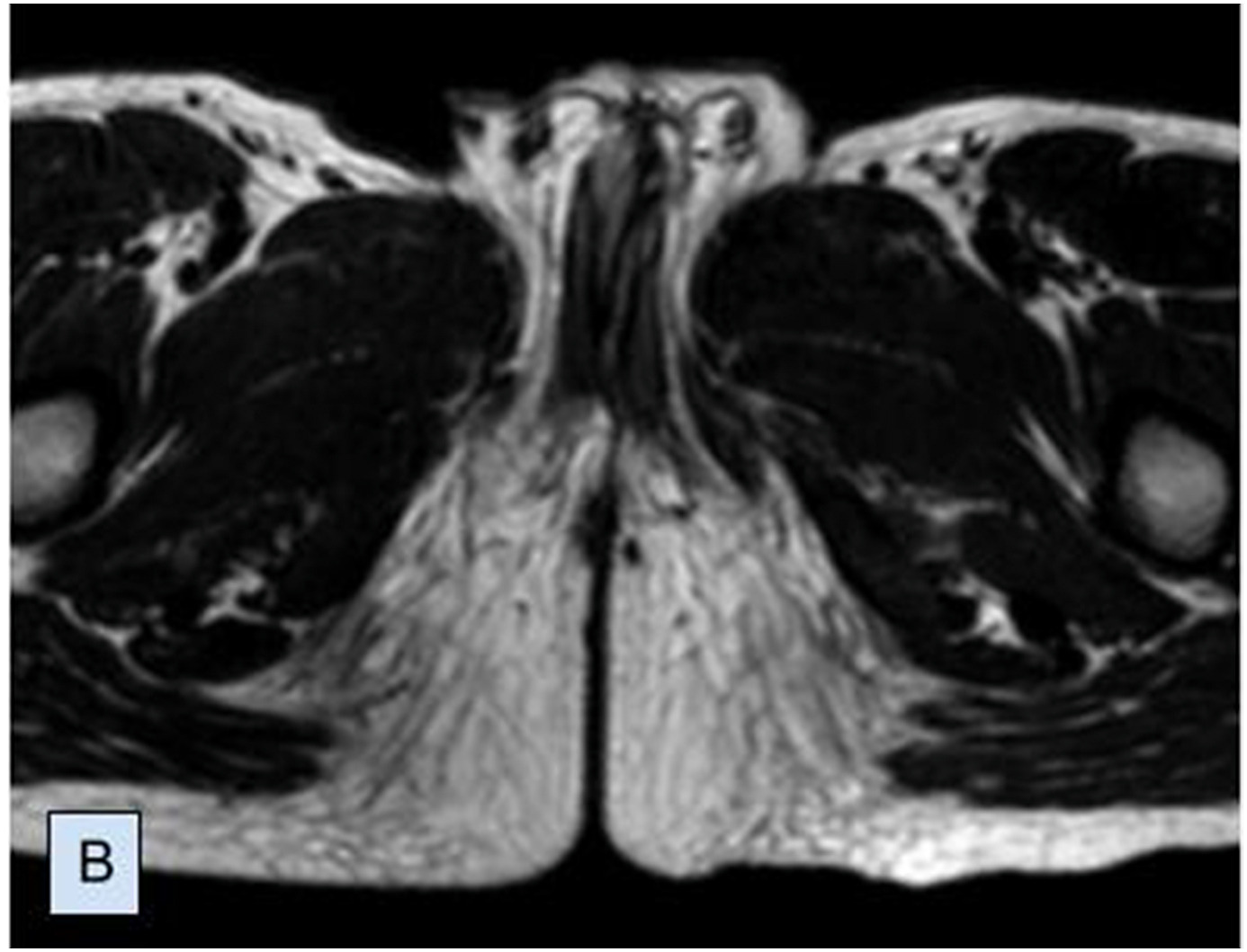 「陰茎重複症」だった7歳男児のX線写真（画像は『ScienceDirect　2021年10月23日付「Complete duplication of the penis - A case report」』のスクリーンショット）