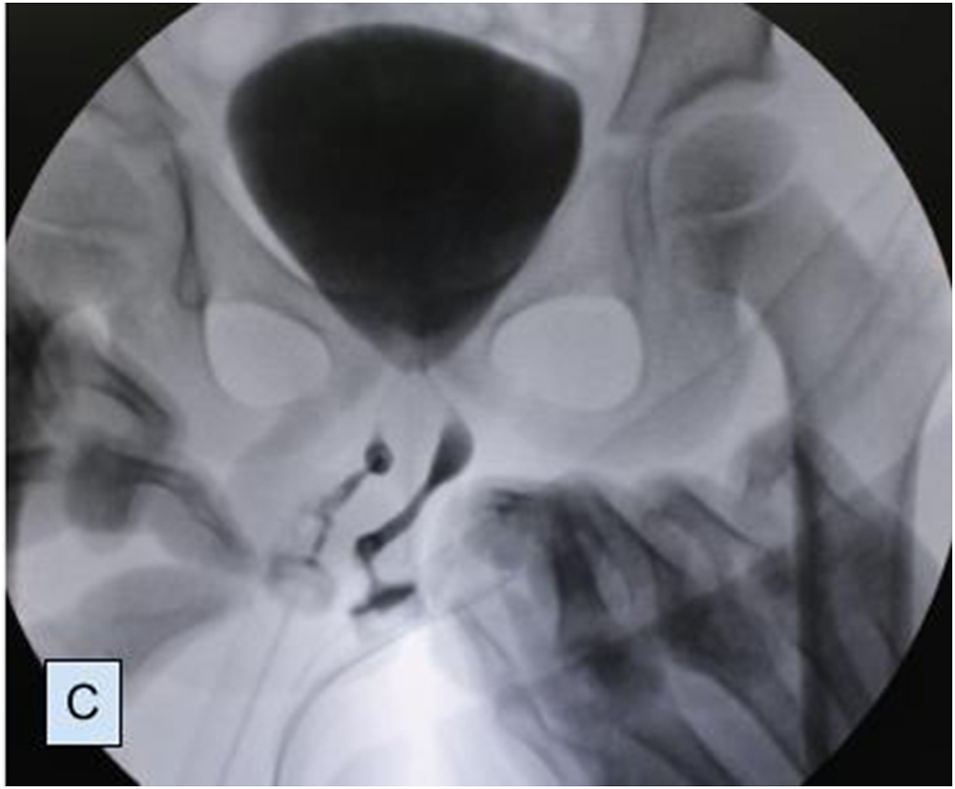 両方の男性器から排尿が可能だった（画像は『ScienceDirect　2021年10月23日付「Complete duplication of the penis - A case report」』のスクリーンショット）