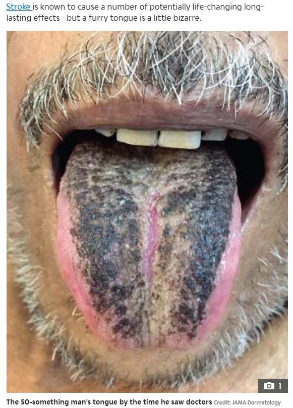 脳卒中を患った後に舌に黒い毛のようなものが（画像は『The Sun　2022年3月11日付「HAIR RAISING Man’s tongue mysteriously turns black and grows HAIRS after stroke」（Credit: JAMA Dermatology）』のスクリーンショット）