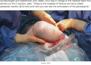 子宮から取り出される羊膜（画像は『LADbible　2022年3月26日付「​Twin Born Still Inside Amniotic Sac In Very Rare Event」（Credit: CEN）』のスクリーンショット）