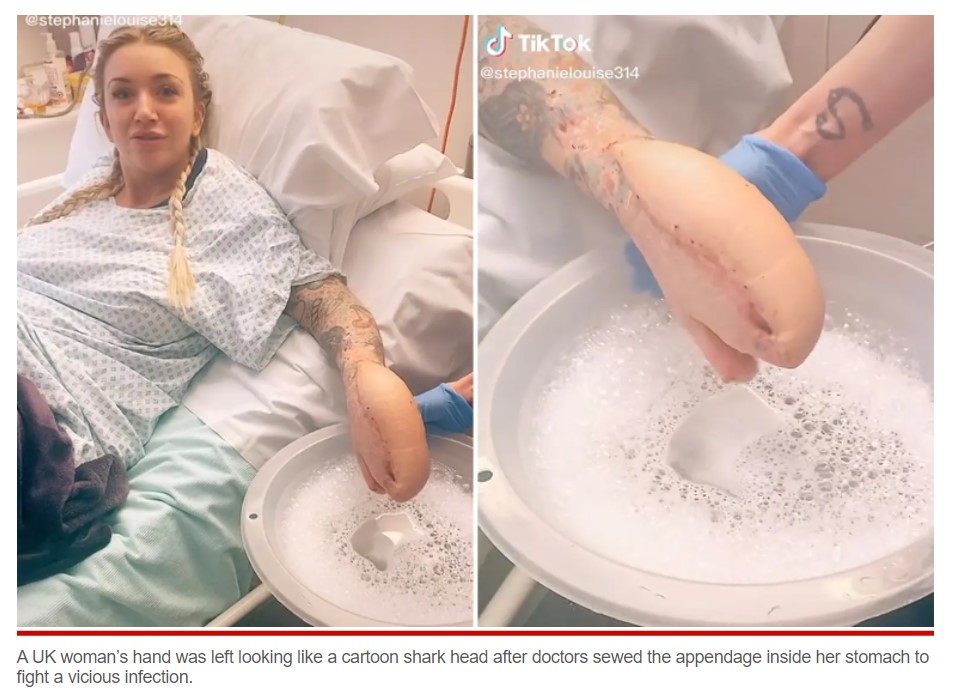 シャークハンドを披露するサディさん（画像は『New York Post　2022年3月22日付「Woman left with ‘shark hand’ after doctors sew it inside stomach during surgery」』のスクリーンショット）