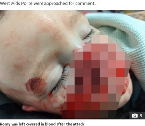 事故の後血まみれだったローミー君（画像は『The Sun　2022年4月18日付「DEVIL DOG MAULING Mum’s warning as horror pics show how toddler son, 2, nearly had his face ripped off by family dog」（Credit: Kennedy News）』のスクリーンショット）