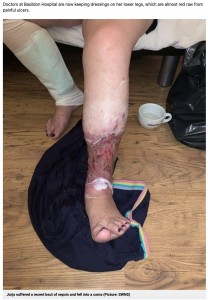 皮膚が欠損したジョルジャさんの脚（画像は『Metro　2022年5月24日付「Woman could lose both her legs after gnat bite 13 years ago」（Picture: SWNS）』のスクリーンショット）