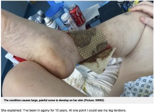 敗血症で両脚切断の危機に（画像は『Metro　2022年5月24日付「Woman could lose both her legs after gnat bite 13 years ago」（Picture: SWNS）』のスクリーンショット）