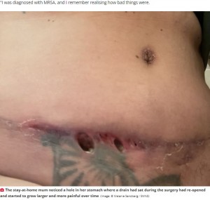 お腹に開いた穴（画像は『The Daily Star　2022年5月30日付「Woman left with gaping hole in tummy after spending ￡16,000 on ‘mummy makeover’」（Image: （C） Melanie Sandberg / SWNS）』のスクリーンショット）