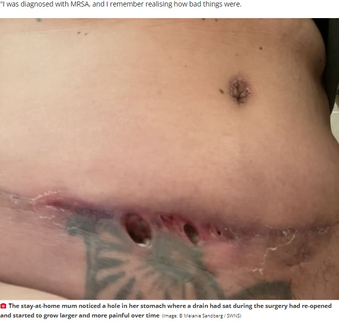 お腹に開いた穴（画像は『The Daily Star　2022年5月30日付「Woman left with gaping hole in tummy after spending ￡16,000 on ‘mummy makeover’」（Image: （C） Melanie Sandberg / SWNS）』のスクリーンショット）