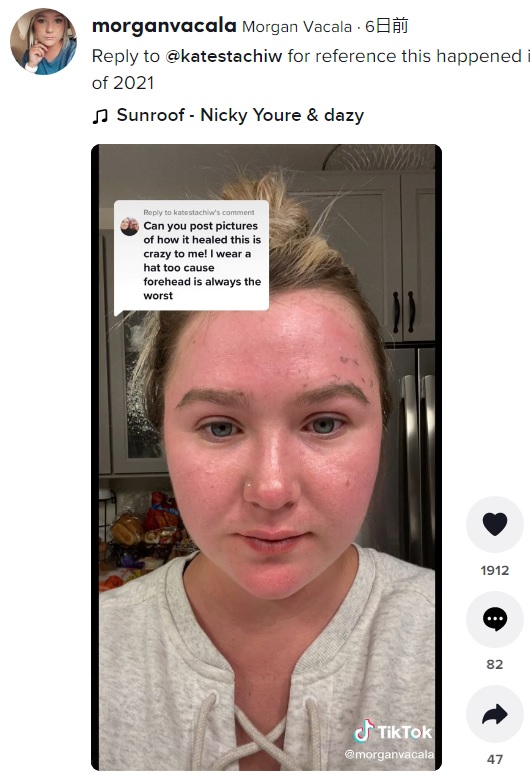 熱傷から数週間後にキレイなおでこを取り戻した女性（画像は『Morgan Vacala　2022年6月2日付TikTok「Reply to ＠katestachiw for reference this happened in central Illinois May of 2021」』のスクリーンショット）