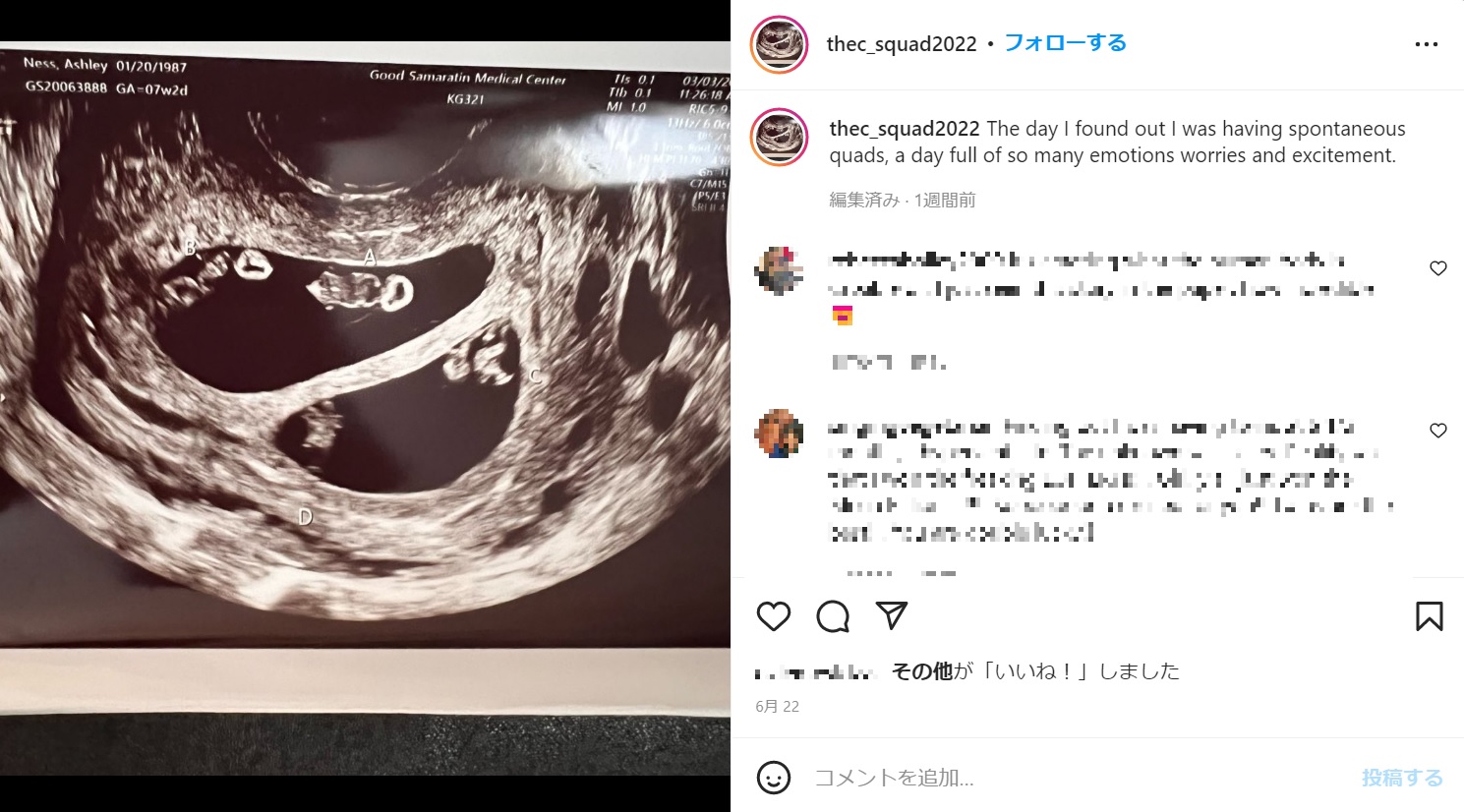 4人の胎児が写るエコー写真（画像は『Ashley Ness　2022年6月22日付Instagram「The day I found out I was having spontaneous quads,」』のスクリーンショット）