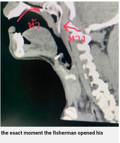 レントゲン写真には、喉から鼻の方へ出ようとしている魚の影が（画像は『Metro　2022年6月1日付「Fisherman almost choked to death when his catch jumped out of water and down his throat」（Picture: Viral Press）』のスクリーンショット）