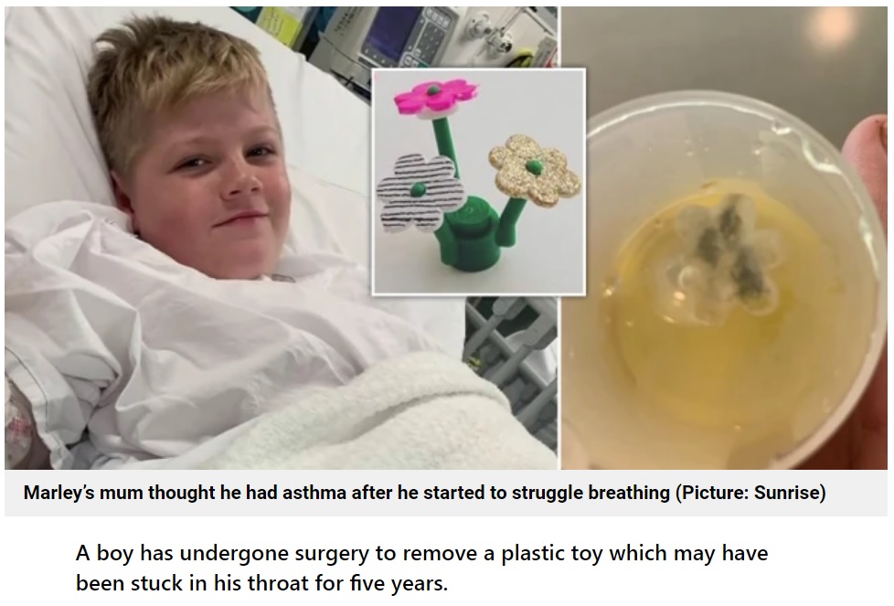 喉にあった花型のプラスチックのおもちゃ（画像は『Metro　2022年8月16日付「Boy’s five-year cough turned out to be toy he swallowed when he was three」（Picture: Sunrise）』のスクリーンショット）