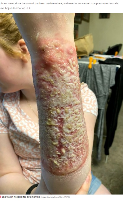 セアカゴケグモに噛まれ重症化した左腕（画像は『The Daily Star　2022年8月22日付「Venomous spider bite leaves mum unable to hug her kids and at risk of cancer」（Image: Courtesy Jenna Allen / SWNS）』のスクリーンショット）