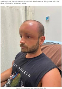 風船のように膨れ上がってしまった頭部（画像は『LADbible　2022年8月30日付「Doctors shocked after man’s head swells to double the size」（Credit: CEN）』のスクリーンショット）