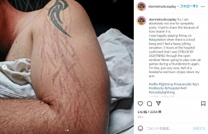 腕には雷に打たれたような火傷の痕が（画像は『Aidan Rowan　2022年9月6日付Instagram「So, I am absolutely not one for sympathy posts, I had to share this because of how insane it is.」』のスクリーンショット）