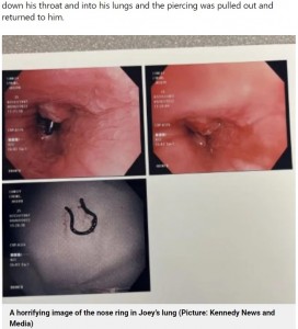 内視鏡カメラが捉えた肺の中の鼻ピアス（画像は『Metro　2022年9月16日付「Man discovers nose ring he ‘lost in the night’ had been lodged in his lung for the last five years」（Picture: Kennedy News and Media）』のスクリーンショット）