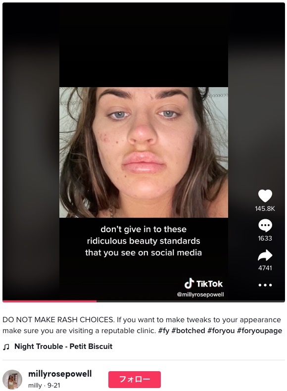 糸リフトの施術を後悔した女性（画像は『milly　2022年9月21日付TikTok「DO NOT MAKE RASH CHOICES.」』のスクリーンショット）