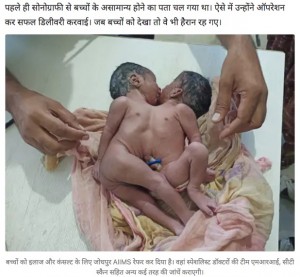 胸部が結合した状態で誕生した双子（画像は『Dainik Bhaskar　2022年10月7日付「दो सिर, चार-चार हाथ पैर, सीने से जुड़े बच्चे जन्मे:AIIMS जांच करेगा अलग होंगे या नहीं, अभी दोनों स्वस्थ」』のスクリーンショット）
