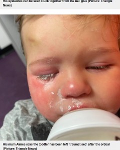 顔が腫れてしまったジャック君（画像は『Metro　2022年10月19日付「Toddler’s eyes glued shut when nursery worker did nails while holding him」（Picture: Triangle News）』のスクリーンショット）