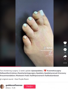 手術後の足の指（画像は『Athena　2022年11月29日付TikTok「Toe shortening surgery： 2 week update」』のスクリーンショット）