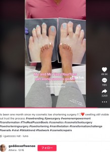 足の指のビフォーアフター（画像は『Athena　2022年12月16日付TikTok「Its been one month since my cosmetic toe shortening surgery !!」』のスクリーンショット）