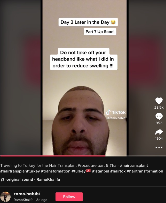 頭が腫れ上がってしまったラモさん（画像は『RamoKhalifa　2022年12月1日付TikTok「Traveling to Turkey for the Hair Transplant Procedure part 6」』のスクリーンショット）