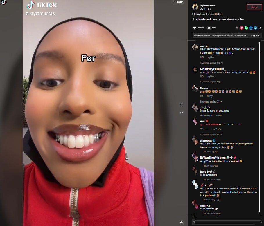 上顎の歯列を治療中の女性（画像は『Lay　2022年11月1日付TikTok「Idk hvad jeg skal sige」』のスクリーンショット）