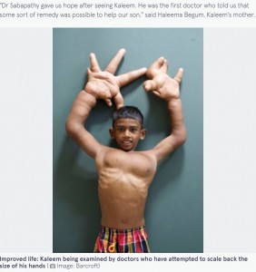 手術を受ける前のムハンマドさんの手（画像は『The Mirror　2015年8月14日付「‘Boy with the World’s Biggest Hands’ measuring 33cm has surgery to reduce their size」（Image: Barcroft）』のスクリーンショット）