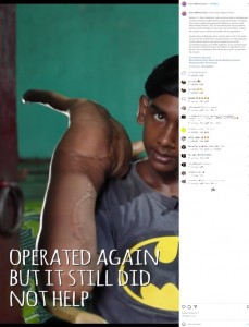 手術痕を見せるムハンマドさん（画像は『Born Different　2021年9月25日付Instagram「I Have India’s Biggest Hands」』のスクリーンショット）