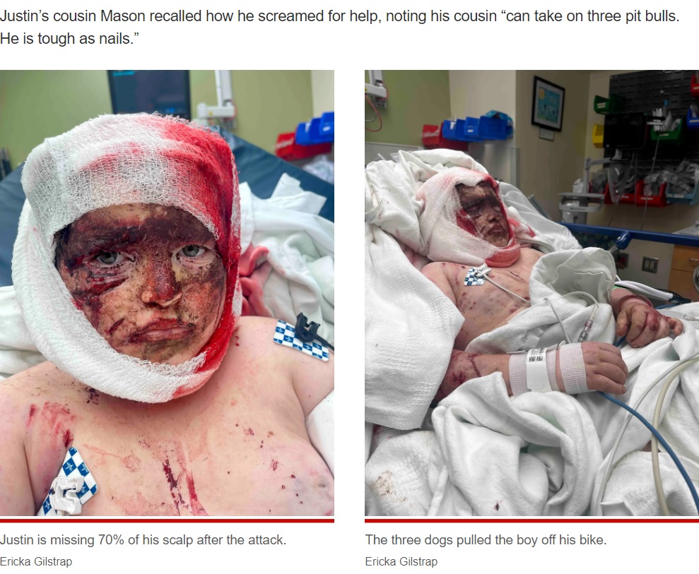 傷と痣だらけだというジャスティン君（画像は『New York Post　2023年1月10日付「Georgia boy severely injured after being pulled off bike, attacked by pit bulls」（Ericka Gilstrap）』のスクリーンショット）