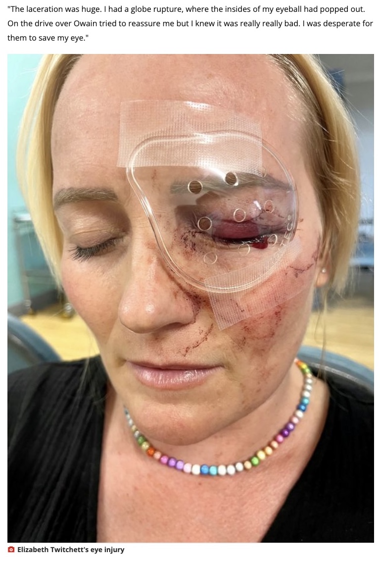 事故直後のエリザベスさん（画像は『WalesOnline　2023年2月12日付「Mum suffered freak ‘Final Destination’ injury when broken fish tank pierced her eyeball」』のスクリーンショット）