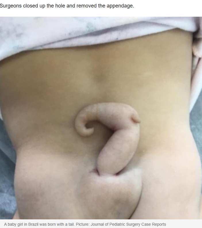 豚の尻尾のような突起物（画像は『news.com.au　2023年2月18日付「Brazilian baby girl born with 6 cm long tail」（Picture: Journal of Pediatric Surgery Case Reports）』のスクリーンショット）