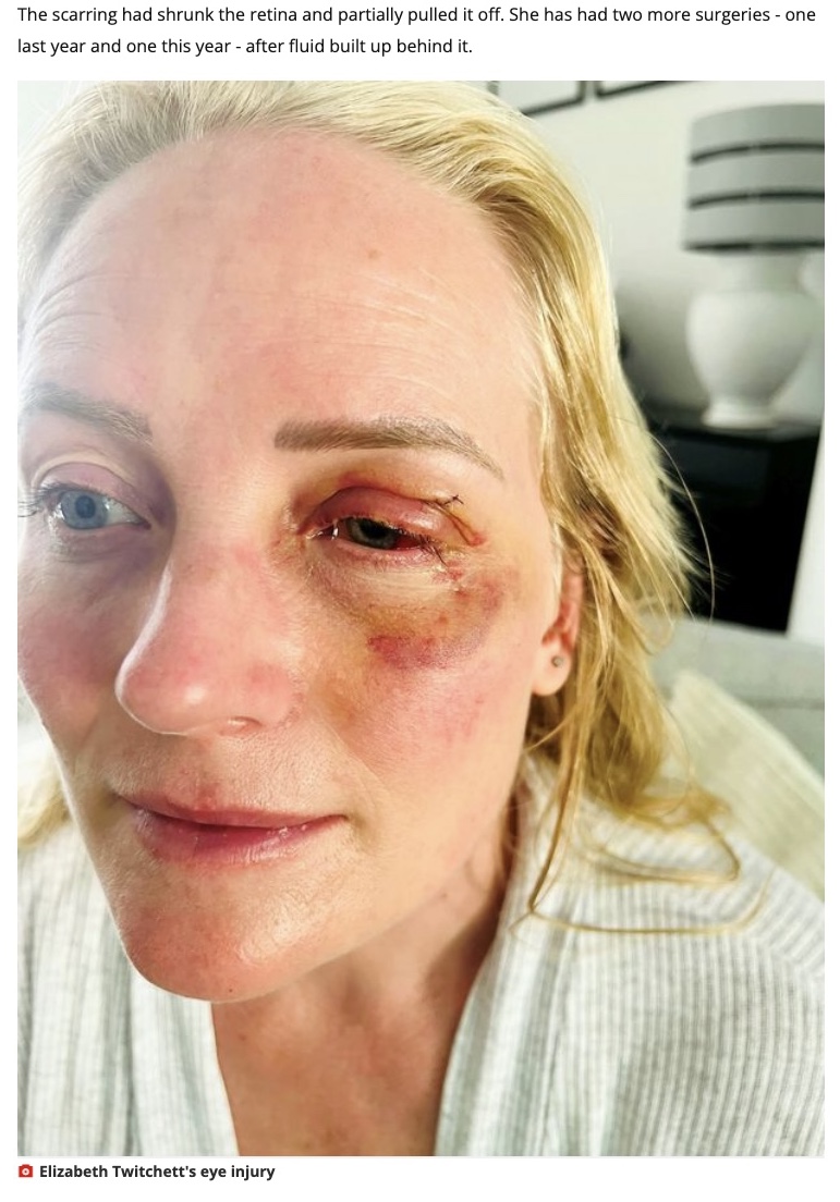 緊急手術を受けたエリザベスさん（画像は『WalesOnline　2023年2月12日付「Mum suffered freak ‘Final Destination’ injury when broken fish tank pierced her eyeball」』のスクリーンショット）