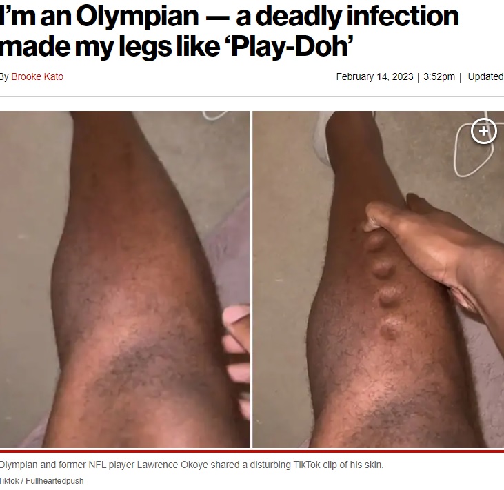 指で押すとなかなか元に戻らない脚（画像は『New York Post　2023年2月14日付「I’m an Olympian ― a deadly infection made my legs like ‘Play-Doh’」（Tiktok / Fullheartedpush）』のスクリーンショット）