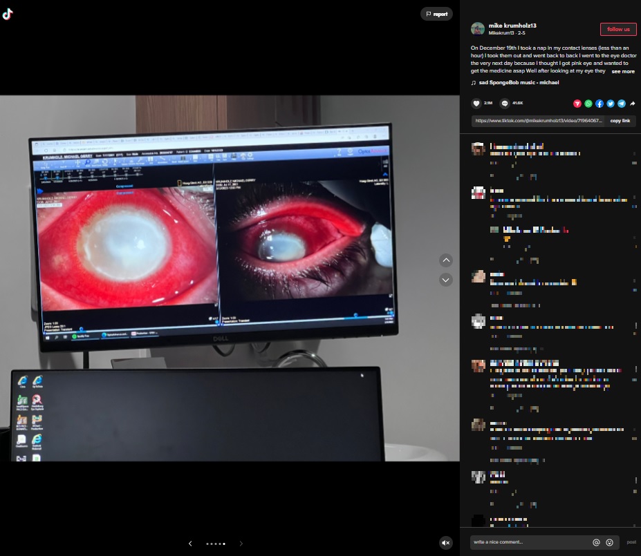 角膜移植となった右目（画像は『Mikekrum13　2023年2月5日付TikTok「On December 19th I took a nap in my contact lenses」』のスクリーンショット）
