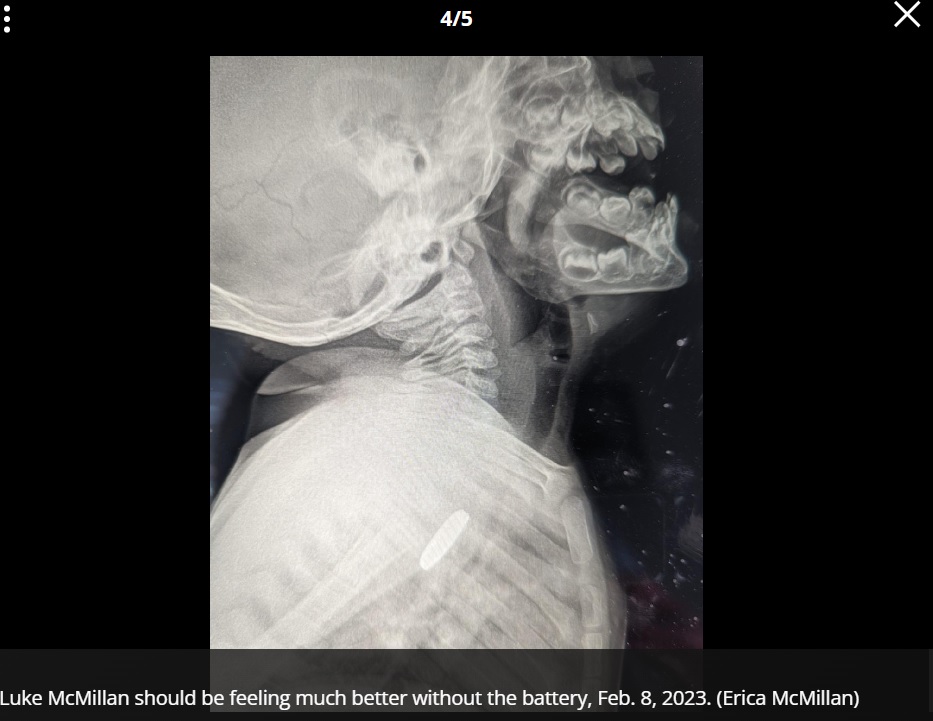 レントゲンで判明した誤飲（画像は『FOX 11　2023年2月8日付「Too much in toddler's x-ray: Battery found lodged in his esophagus for weeks」（Erica McMillan）』のスクリーンショット）