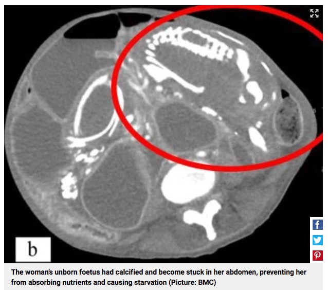 死亡した50歳女性の腹部（画像は『Metro　2023年3月10日付「Woman died of starvation after carrying unborn foetus inside her for nine years」（Picture: BMC）』のスクリーンショット）