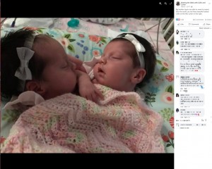 【海外発！Breaking News】「中絶を」と言われた結合双生児の姉妹、分離せず元気な6歳に（米）＜動画あり＞