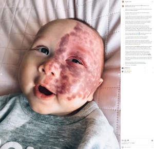 レーザー治療後のキングズレー君。治療直後の皮膚は赤い斑点が残り痛々しいが、10日もすると斑点がなくなり色も抜けてくるという。ただこの治療に対し「小さな子にレーザーなど必要ない」「モンスターママ」などの心無いコメントが相次いだ（画像は『Kingsley W　2022年12月12日付Instagram「PWS laser treatments」』のスクリーンショット）
