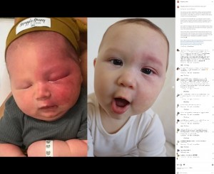 顔の左半分を赤いあざで覆われる「ポートワイン母斑（ポートワイン血管腫）」を患い誕生したキングズレー君。先天性の指定難病「スタージ・ウェーバー症候群」であることも判明し、レーザー治療を3回終えた後の写真が右側。ずいぶんきれいになっている（画像は『Kingsley W　2022年9月1日付Instagram「Do the laser treatments really work?」』のスクリーンショット）