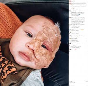 2回目の「パルス色素レーザー」の治療前に顔に麻酔クリームを塗布。2度目はこのまま40分待った後、医師に呼ばれレーザーを約2分間照射してもらった。まだ幼いだけに、じっとしているのは大変だったようだ（画像は『Kingsley W　2022年6月28日付Instagram「The numbing process before laser treatment 2」』のスクリーンショット）