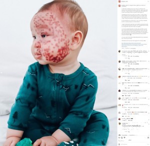 3度目のレーザー治療後のキングズレー君。皮膚を健康に保つだけでなく、放置するとあざが濃くなったり、盛りあがったり、出血したりといった症状が出ることがあるため、1歳前に行うと有効だという（画像は『Kingsley W　2022年8月10日付Instagram「The happiest little boy」』のスクリーンショット）